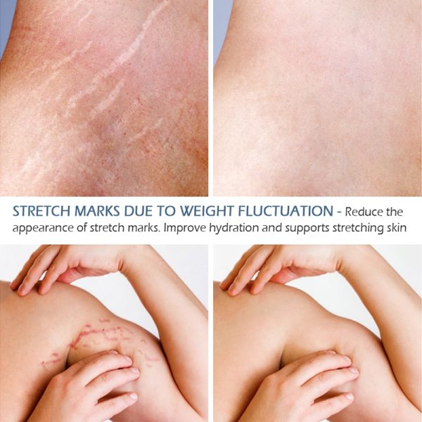 Stretch Marks Remover Essential Oil Skin Care Treatment Cream For Stretch Mark Removal Maternity Slackline For Pregnant Oils – Essential Oil 3