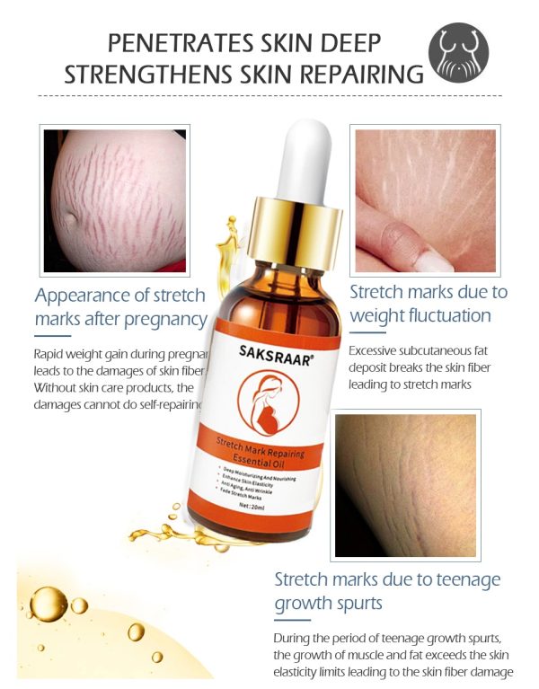 Stretch Marks Remover Essential Oil Skin Care Treatment Cream For Stretch Mark Removal Maternity Slackline For Pregnant Oils – Essential Oil 4